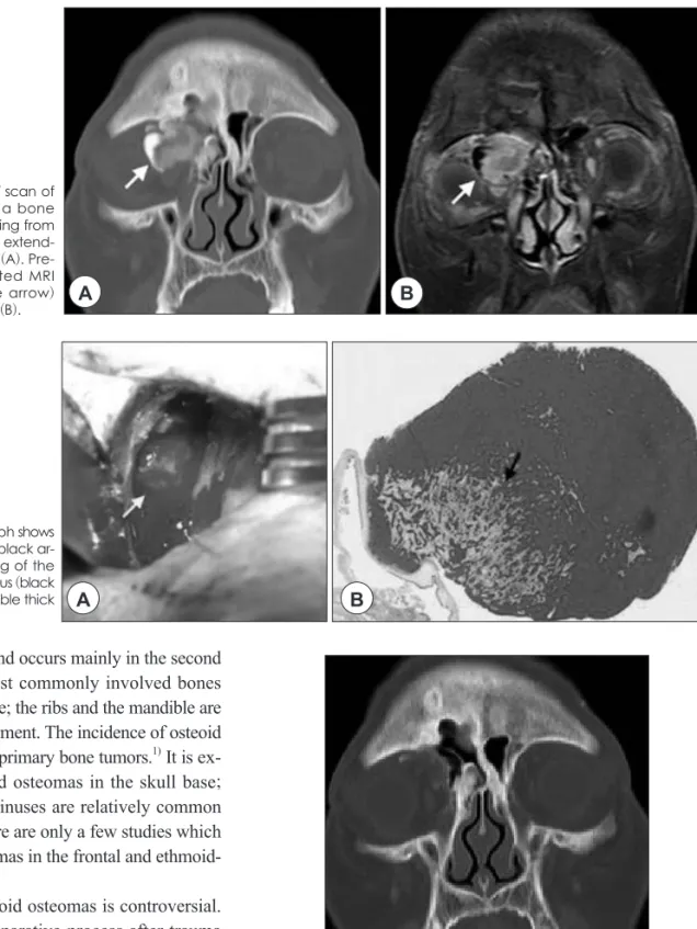 Fig. 3. Post-operative coronal CT scan of the paranasal sinuses  performed 1year later shows no evidence of tumor recurrence.