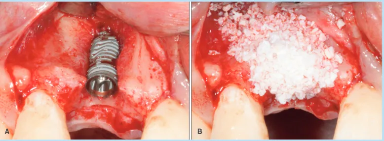Fig. 3. 	Intraoral	photos	at	implant	placement	and	guied	bone	regeneration.	(A)	Placement	of	the	implant	resulted	in	a	buccal	 dehiscence.	(B)	Peri-implant	dehiscence	was	corrected	with	guided	bone	regeneration	techniques.