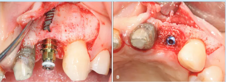 Fig. 10. 	Intraoral	photos	at	soft	tissue	augmentation	using	vascularized	interpositional	periosteal	connective	tissue	graft.	A	 soft	tissue	graft	was	placed	in	effort	to	convert	the	biotype	of	gingiva	at	site	#22	from	thin	to	thick.	(A)	The	palatal	donor	