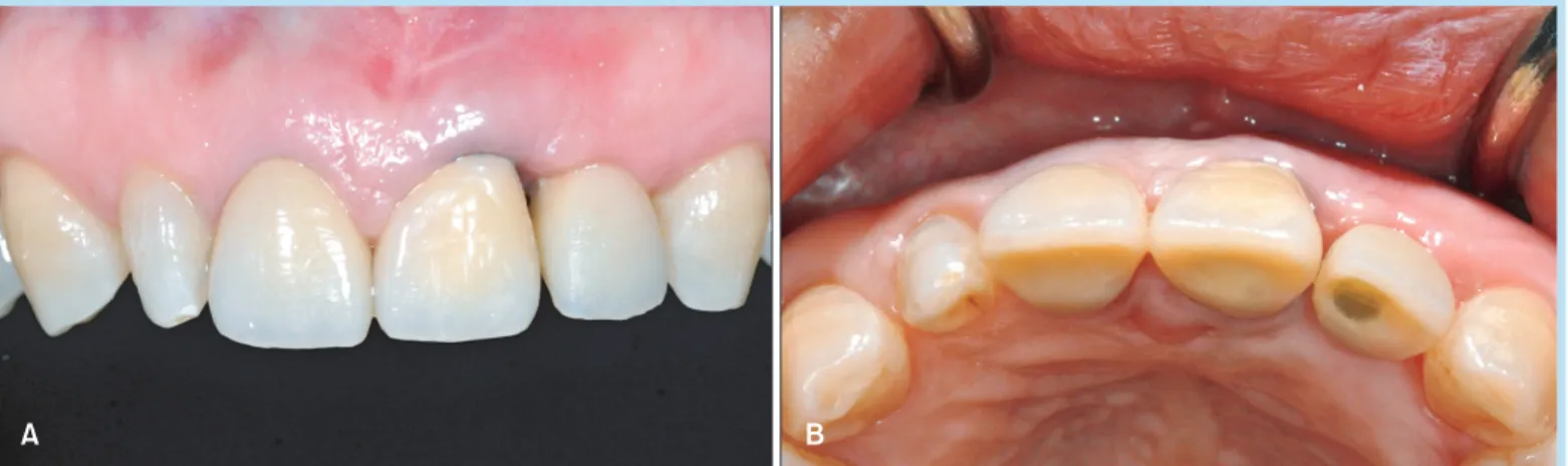 Table 1.  Evaluation of the outcome using esthetic parameters (Case 1)