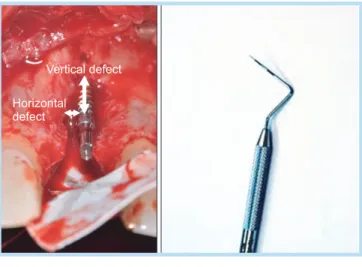 Table 3.  Implant system