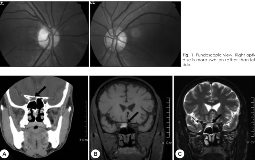 Fig. 1. Fundoscopic view. Right optic  disc is more swollen rather than left  side.