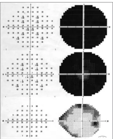 Fig. 4. Visual field analysis (VFA). Preoperative VFS shows com- com-plete visual field defect of right eye (top)