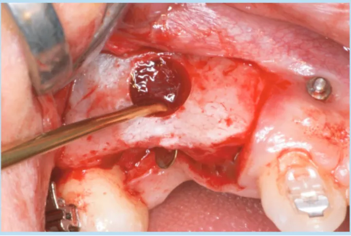 Fig.  6.   When  the  right  maxillary  sinus  graft  was  performed, the communication of #15 extraction socket and  the maxillary sinus was confirmed.