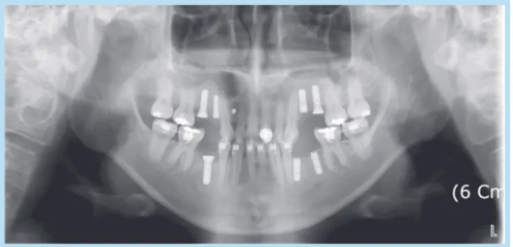 Fig. 11.  Clinical photograph after temporary setting of final restorations.