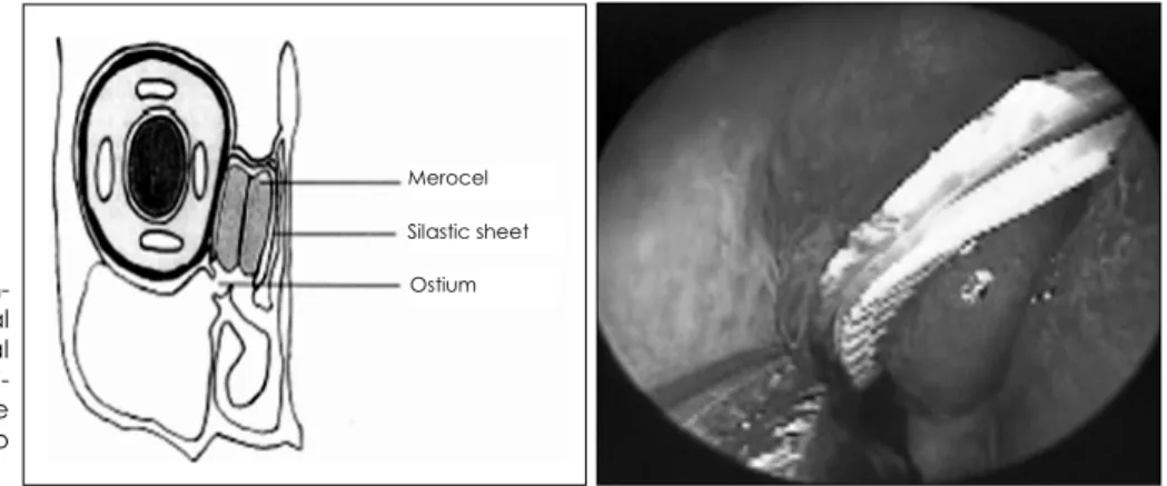 Fig. 3. Schematic representation of en- en-donasal reconstruction of the medial orbital wall