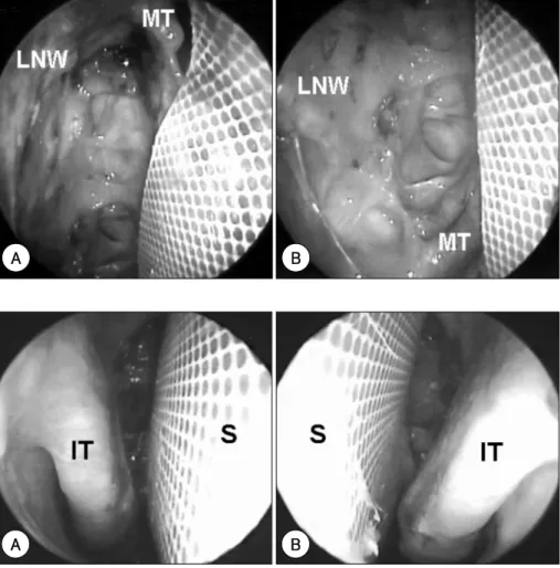 Fig. 7. Endoscopic view of nasal cavity after fixation of the silastic sheet to  sep-tum, providing sufficient space for  com-fortable nasal breathing
