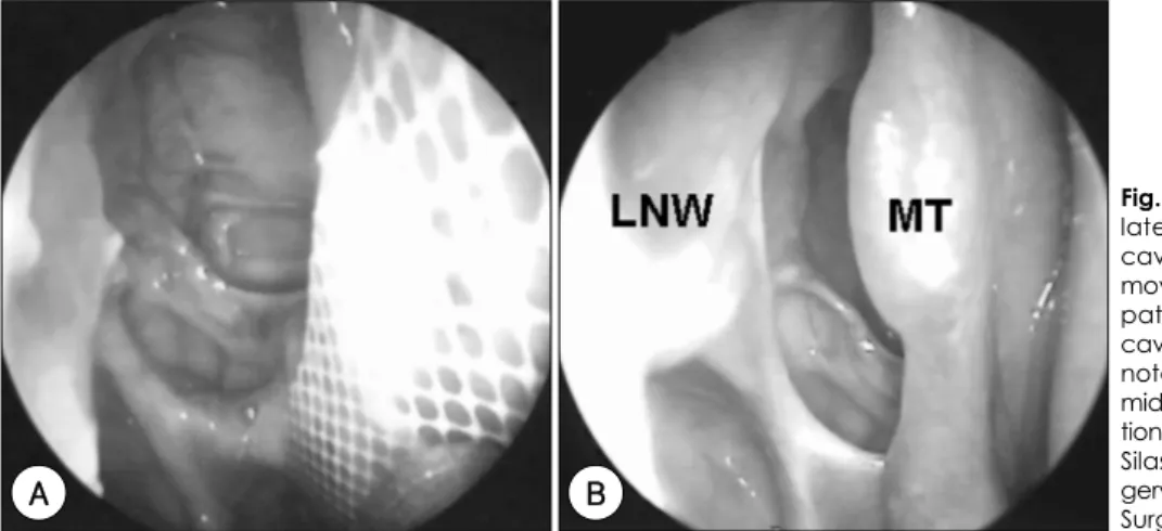 Fig. 8. A：Healed mucosal surface of  lateral nasal wall and clear ethmoid cavity can be observed