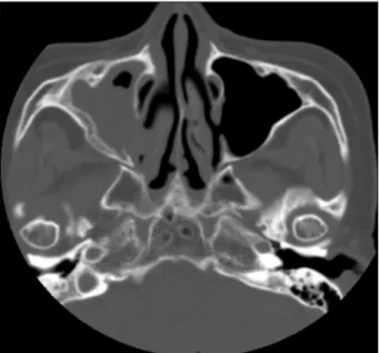 Fig. 1. Calcification of the both maxillary sinuses on ostiomeatal unit CT was observed