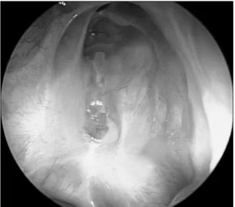 Fig. 5. 6 months post-operative nasal endoscopic finding of right nasal cavity. This shows the closure of bony defect shown previously