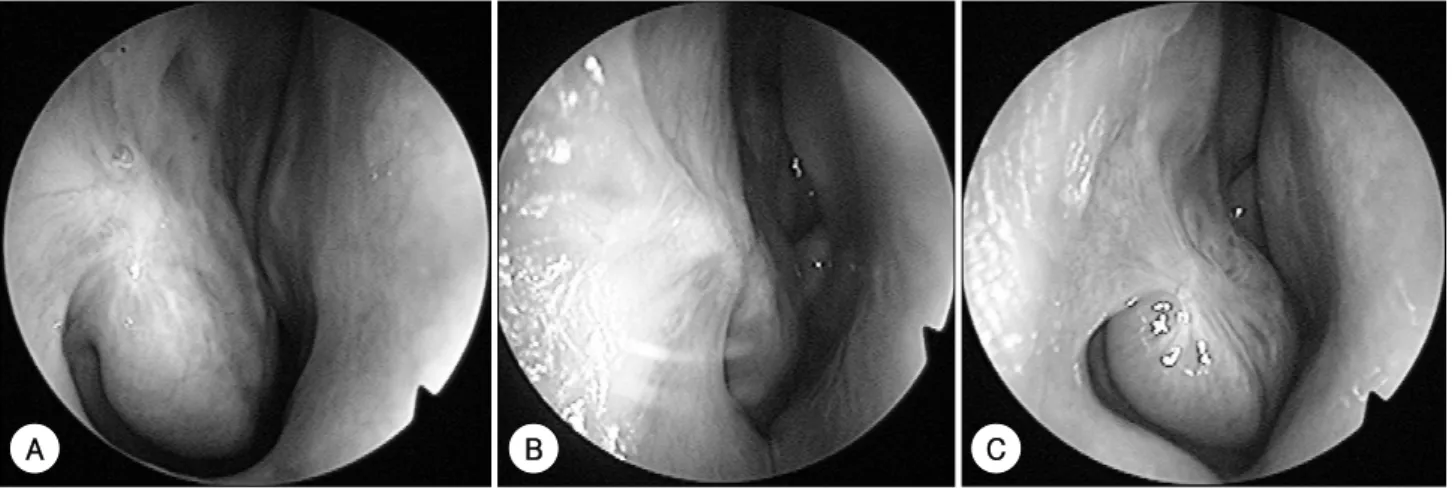 Fig. 5. Postoperative nasal endoscopic finding of patients. Nasal endoscopy shows postoperative scars without residual mass and evidence of recurrence (A, B：Patient 1, 2 MALT lymphoma), (C：Patient 4 lymphoid hyperplasia)