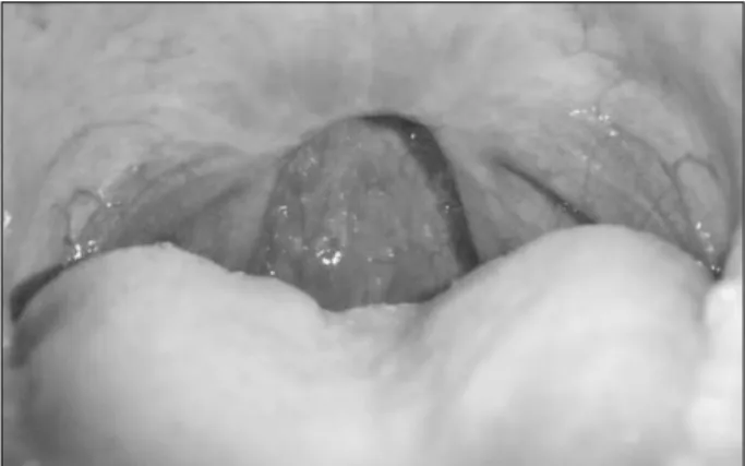 Fig. 4. The well healed mucosa of the soft palate at 6 months postoperatively. 
