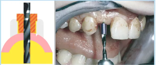 Fig.  11.   Use  of  surgical  guide  prefabricated in the Lab (NobelDirect ® ) 35 .