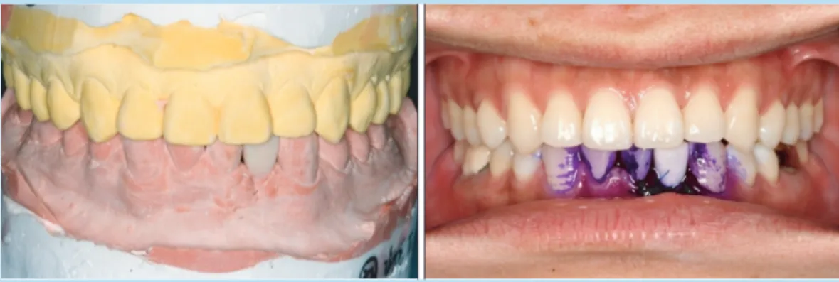 Fig. 12.  Provisional restoration by  indirect technique.