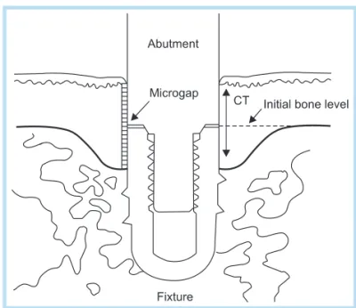 Fig. 1.  Implant-abutment junction (microgap).