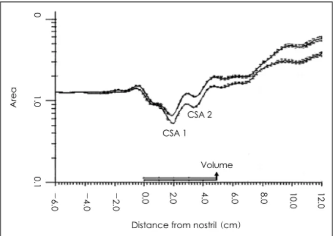 Fig. 1. Sample acoustic rhinometry graph. The first valley is CSA 1, and the second valley is CSA 2
