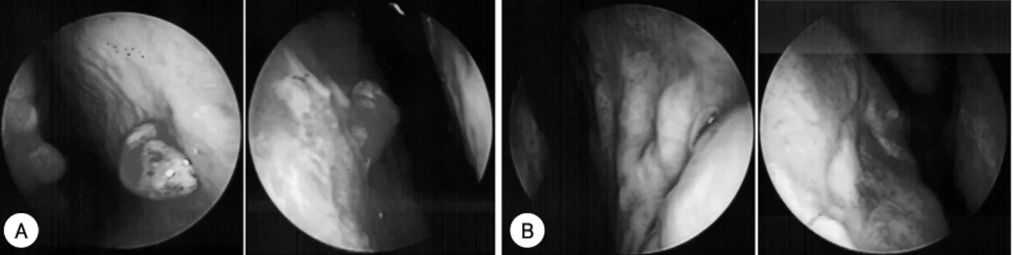 Fig. 2. Postoperative endoscopic view. A：Postoperative finding at 1 month after the procedure