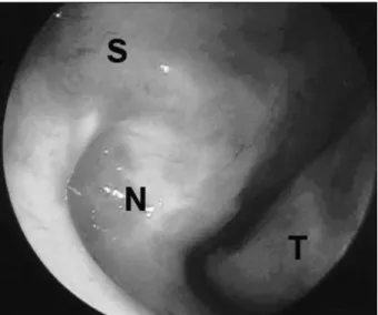 Fig. 1. Nasal endoscopic finding revealed the floor of the left- left-side nasal cavity to be elevated posteriorly and the nasal  sep-tum deviated to the right