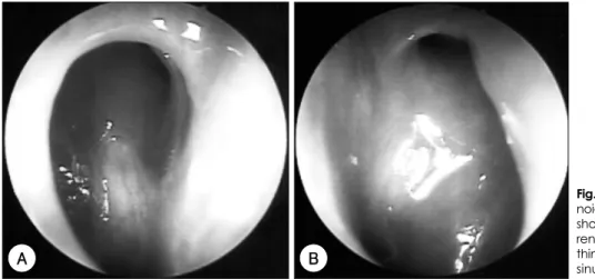 Fig. 4. Endoscopic finding of both sphe- sphe-noid sinus 3 months after radiotherapy shows no evidence of residual or  recur-rent tumor except mucosal edema  wi-thin sphenoid sinus