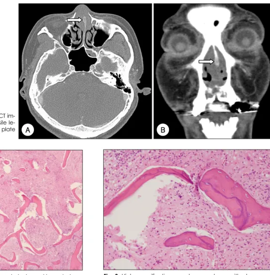 Fig. 1. A：Axial and B：Coronal CT im- im-ages show well-defined, expansile  le-sion (arrow) in the perpendicular plate