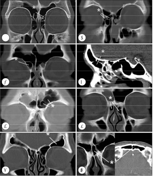 Fig. 1. Paranasal sinus CT scans repre- repre-senting frontal recess cells. A：Type 1  frontal cells (*) are seen above the  ag-ger nasi cell