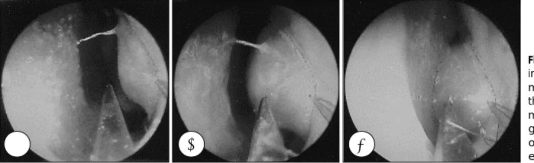 Fig. 1. Representative endoscopic find- find-ings of left inferior turbinates. They were measured  (A) at pre-general  anes-thesia supine position state (B)  at 10  minutes after Rose position state under  general anesthesia (C) at the end of  operation 50