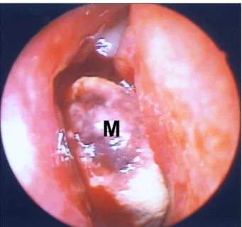 Fig. 2. Coronal CT of paranasal sinus shows the soft tissue mass from the right middle turbinate