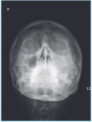 Fig. 3.  Computed tomography scan clearly shows sig- sig-nificant mucosal thickening along the entire  lin-ing of the sinus.