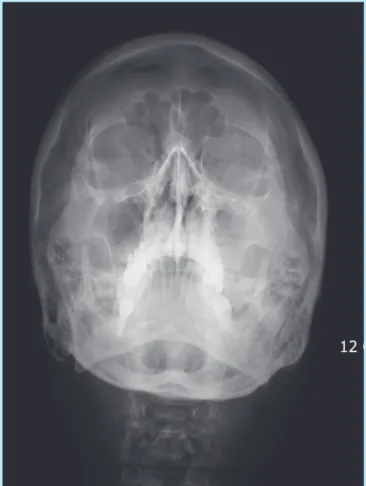Fig. 6.  Panoramic view showing improved radioluceny after 1 month.