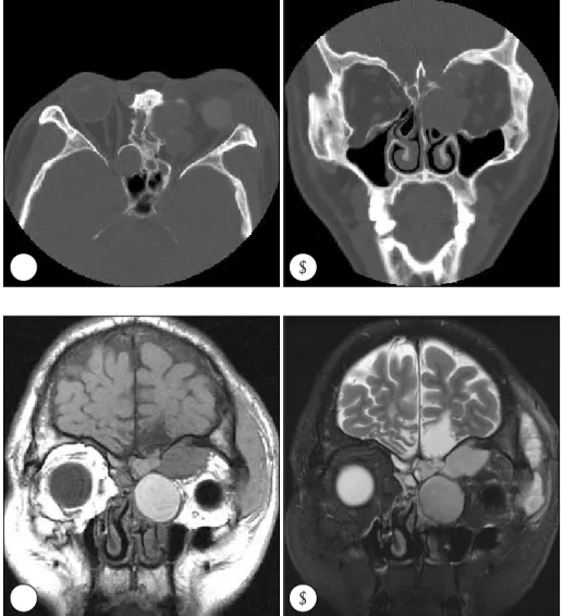 Fig. 1. Preoperative CT image. There is a 1 cm sized bulging contour  reten-sion cyst in the right posterior ethmoid sinus (A)