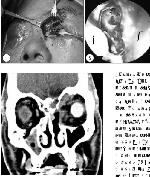Fig. 3. Operative findings. A：The left  fronto-ethmoidectomy via Lynch’s  app-roach. B：The endoscopic  ethmoide-ctomy with the removal of the left  la-mina papyracea