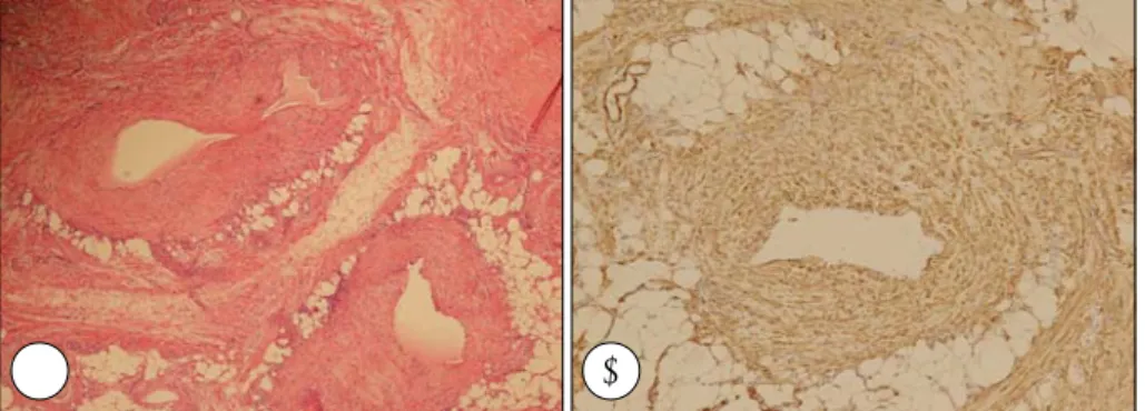 Fig. 4. Histologic finding. A：Submuco- A：Submuco-sal tumor is composed of abundant thick-walled blood vessels blending with  proliferative smooth muscle tissue (H&amp;E；×100)