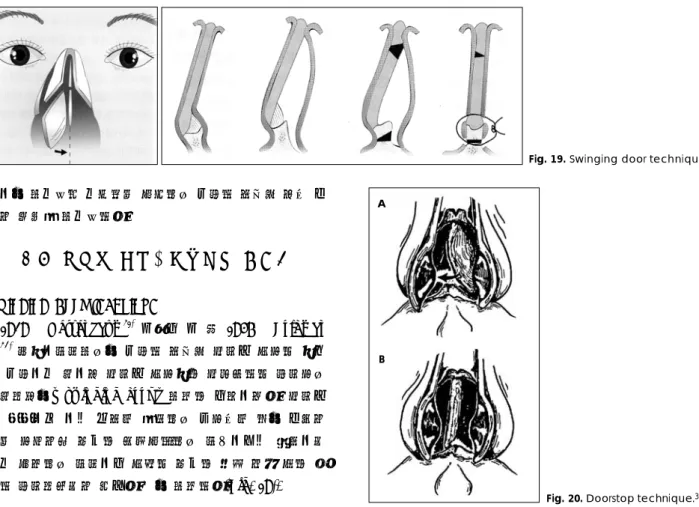 Fig. 19. Swinging door technique.