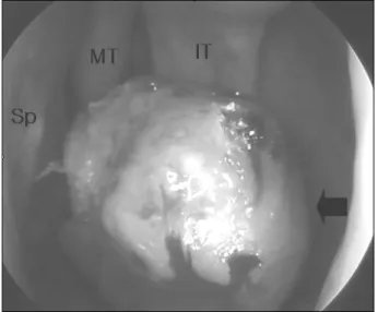 Fig. 2.  A：Scout view for MRA shows marginal enhancement in the mass  le-sion (arrow)