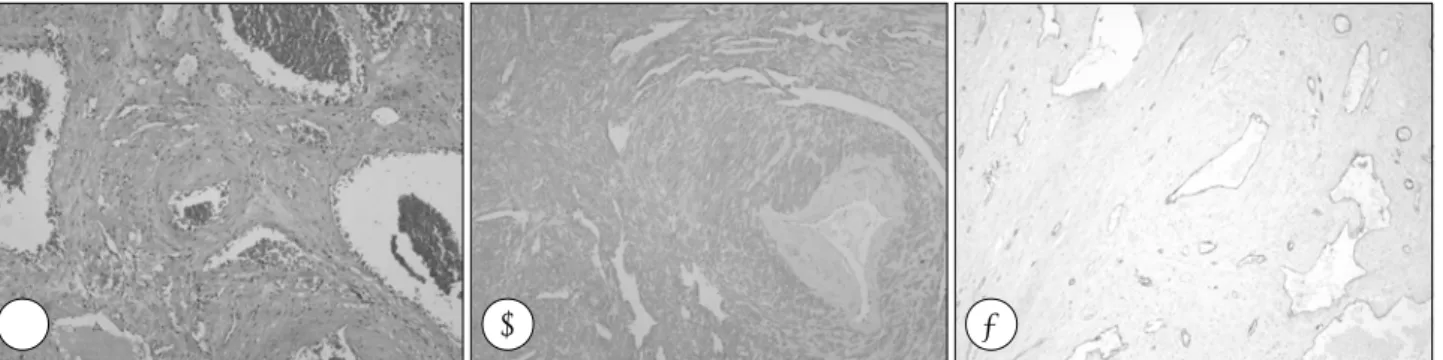 Fig. 3. A：Photomicroscopic finding shows thick-walled blood vessels blending with proliferative smooth muscle tissue (H-E stain, × 100)