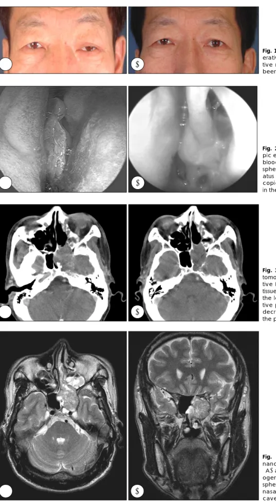 Fig. 1. Pre-operative (A) and post-op- post-op-erative profile (B). After  postopera-tive radiotherapy, the left ptosis had  been improved