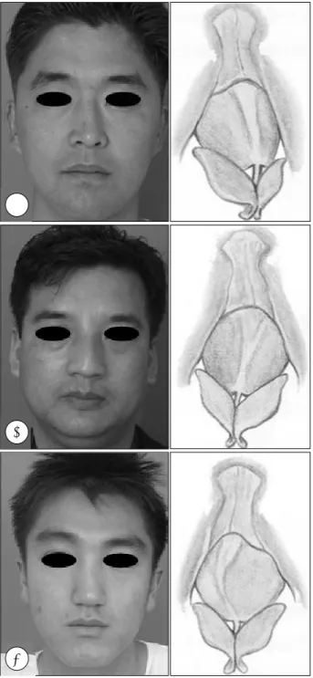 Fig. 1. The types of deviated nose. A：the linear shape of deviated nose showing the bony  axis  of  external  nose  to  the left  side  and  cartilageous  axis  on  the  same  direction