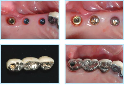 Fig. 13.  3 unit implant restorations using SCP concept.  