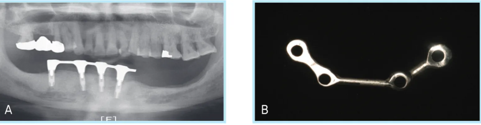 Fig. 1.  The gap between implant and bar due to loss of passive fit ((A A)), implant was failed after 5 years ((B B))