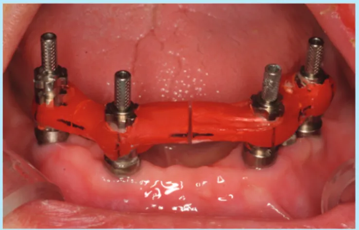 Fig. 3.  Check up the abutment position with resin zig on the model ((A A)) and in the mouth ((B B))