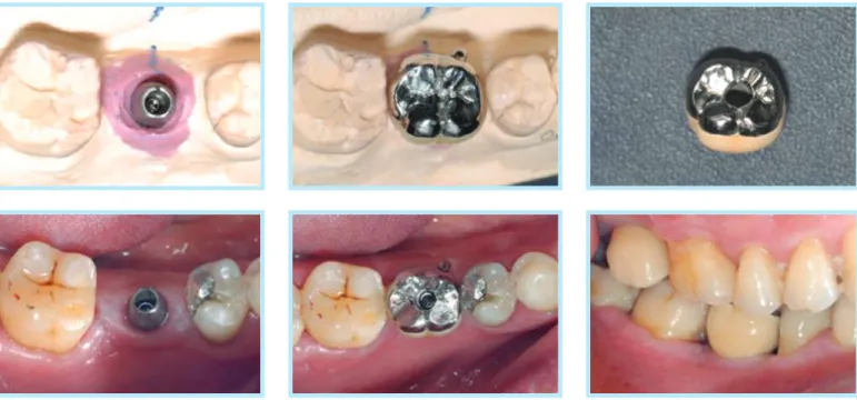 Fig. 8.  Single implant restoration using Screw-Cement Retained Prostheses (SCRP) 22 