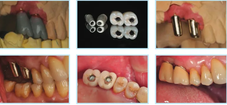 Fig. 9.  Two implant splinted restorations using SCRP concept.