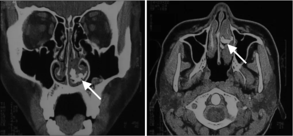 Fig. 4. Endoscopic view of the left nasal cavity shows normal  mucosa (2 weeks after the operation)