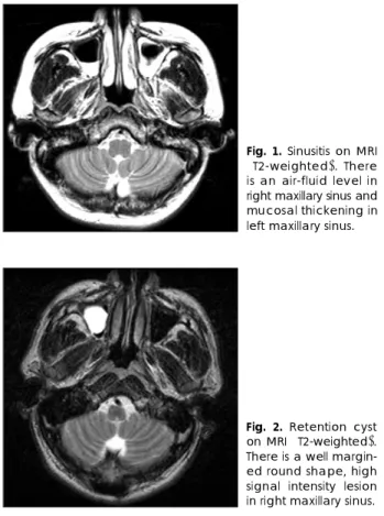 Fig. 1. Sinusitis on MRI (T2-weighted). There is an air-fluid level in right maxillary sinus and mucosal thickening in left maxillary sinus