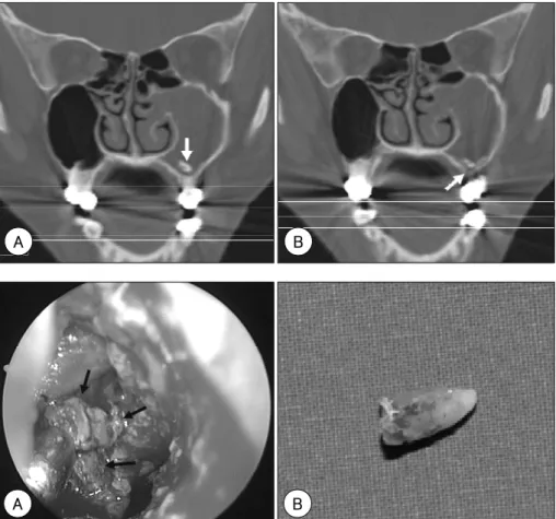 Fig. 1. Preoperative coronal PNS CT scan. A：It shows residual tooth root in left maxillary sinus floor (arrow)