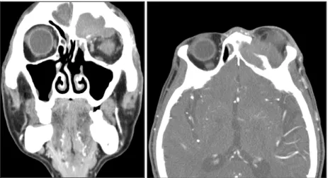 Fig. 2. Coronal and axial view of paranasal si- si-nus CT shows large expansile soft tissue density lesion in left frontal sinus with expanded to  or-bit superior aspect and bony defect