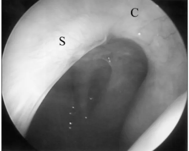 Fig. 6. Postoperative endoscopic finding. There is no mass lesion. S : nasal septum. 