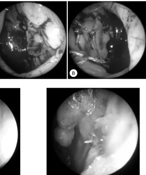 Fig. 5. The site of pedicle transection (2 months after operation) is denoted by the dotted line