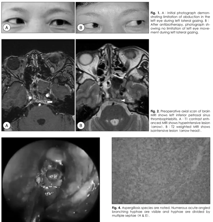 Fig. 1. A：Initial photograph demon- demon-strating limitation of abduction in the left eye during left lateral gazing