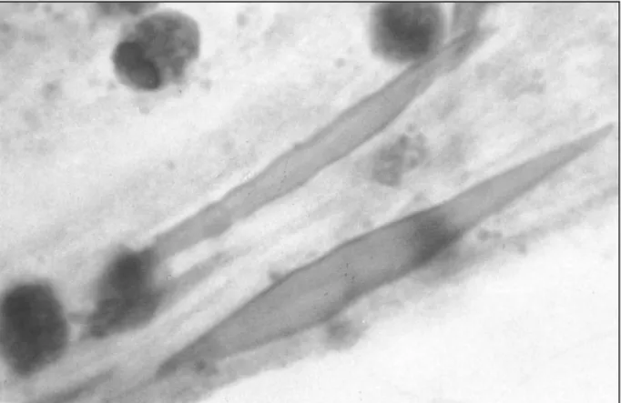 Fig. 3. Charcot-Leyden crystals, they are formed from membrane  of released granules within eosinophils